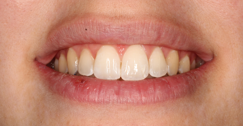 El 68% de la población tiene los colmillos más amarillos que el resto de dientes