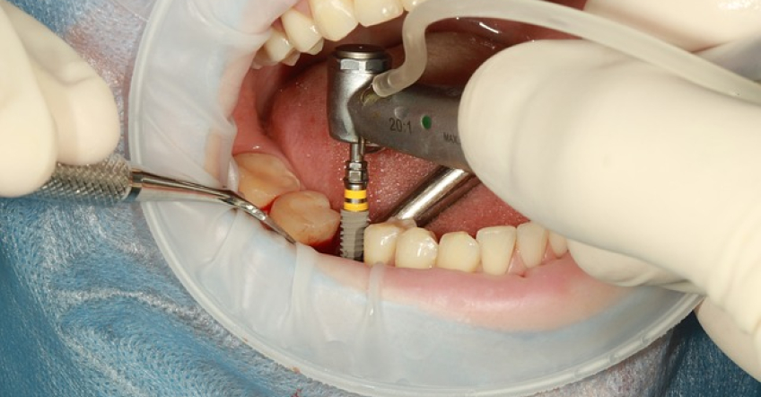 Cuáles son los beneficios de optar por implantes dentales